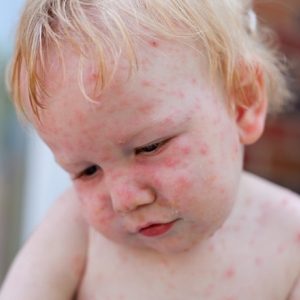 Hand, Foot, and Mouth Disease: Summer’s Epidemic